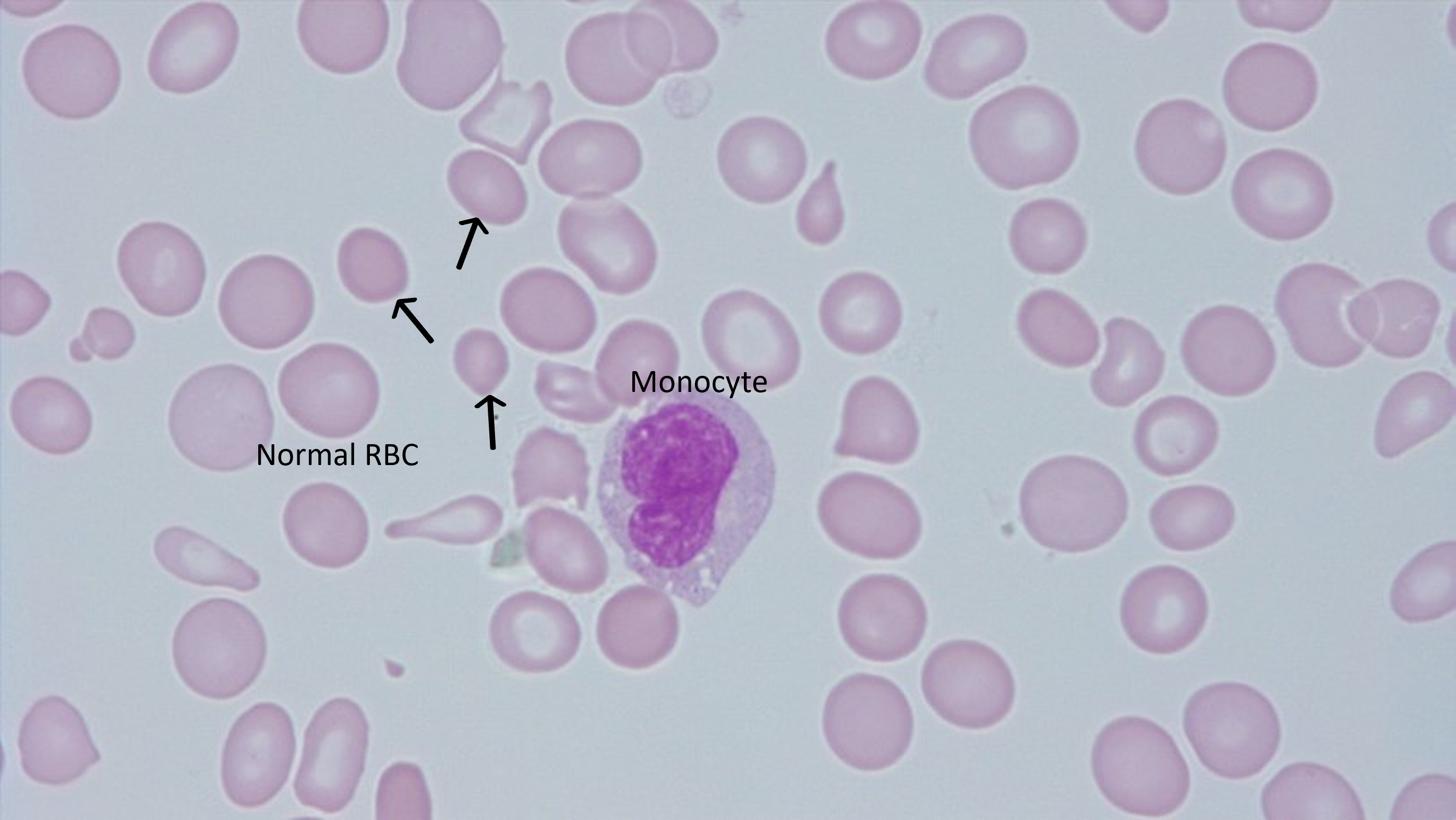 Figure 5-32 from Evaluation of Cell Morphology and Introduction to Platelet  and White Blood Cell Morphology | Semantic Scholar