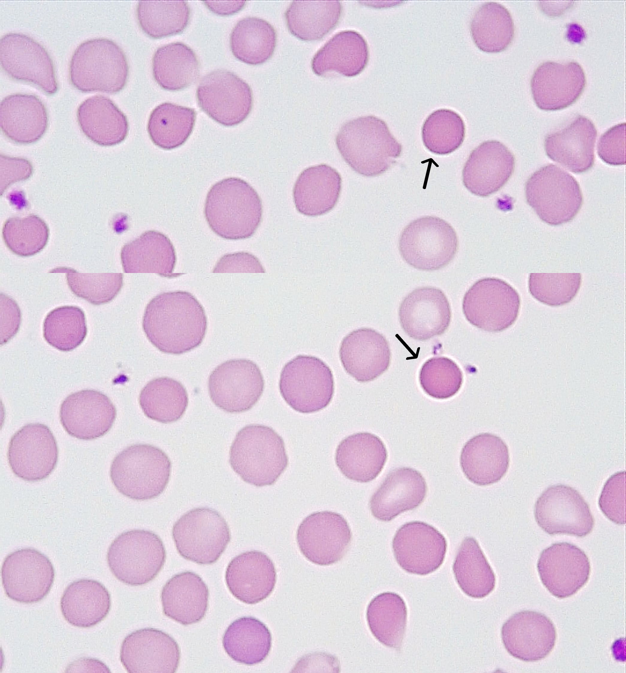 Spirocyte Rbc H5P Resource ID 18086 | LibreStudio