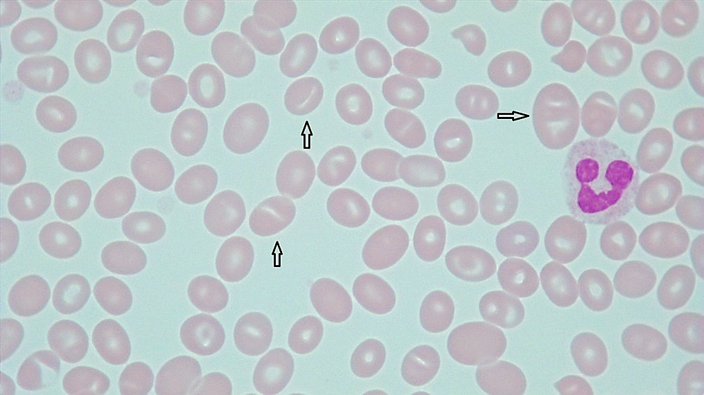 Red Cell Staining (Color) • The Blood Project