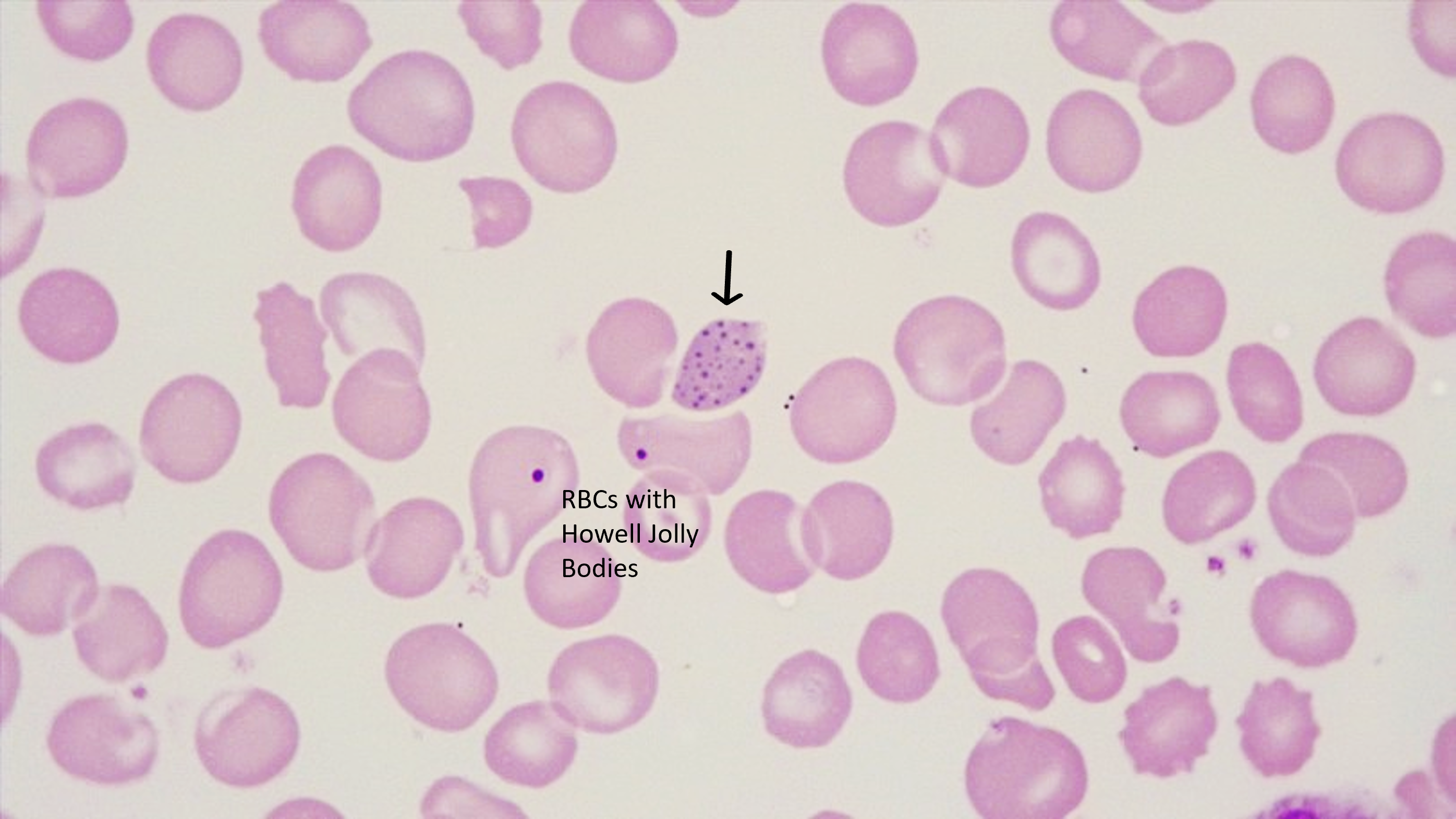 Hematology-3-1 - Hema notes - RBC INCLUSIONS Clarence Witty H. Mendoza, RMT  INCLUSIONS APPEARANCE/ - Studocu