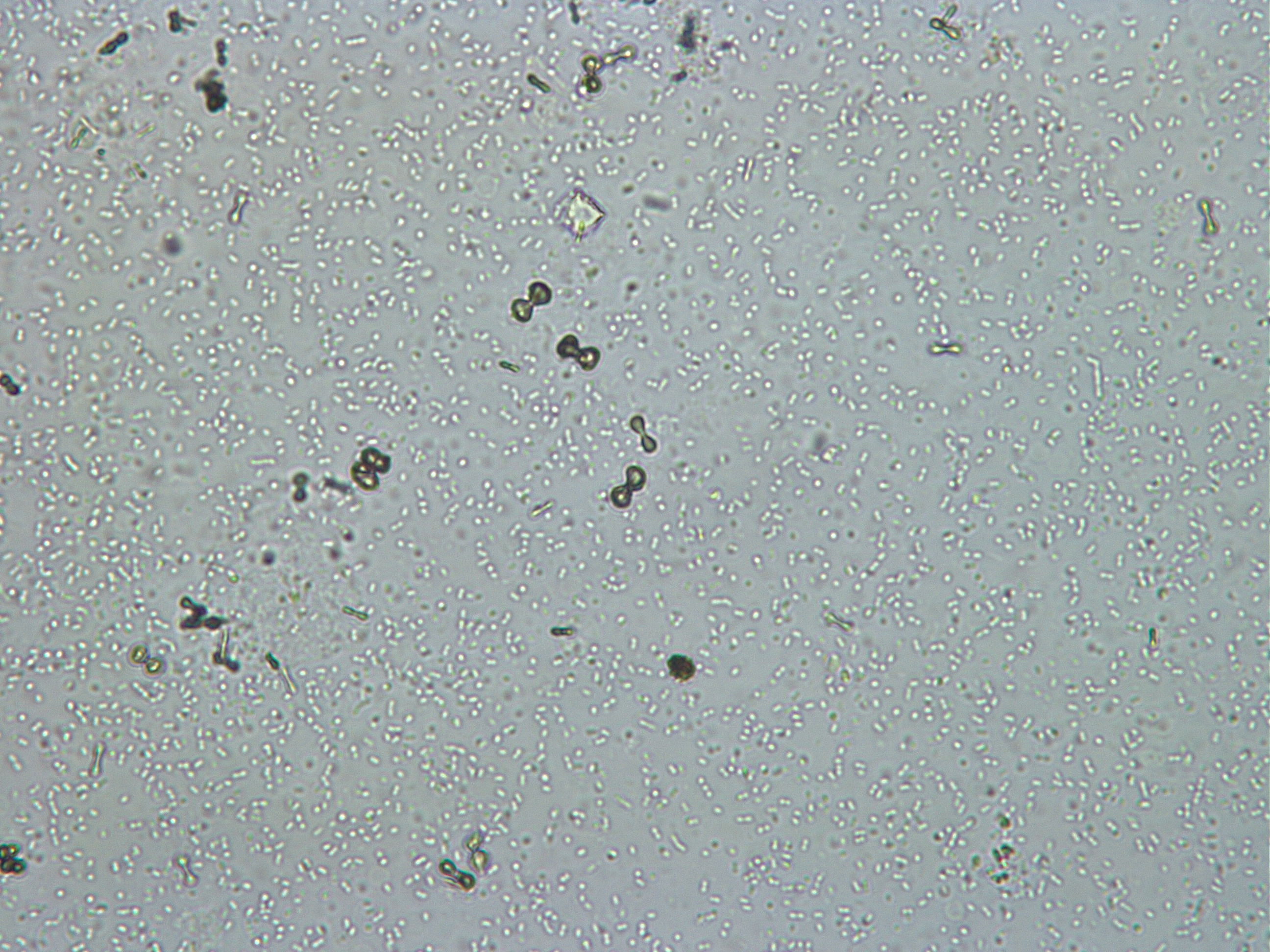 radiographic dye crystals in urine